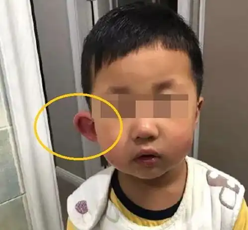 宝宝被蚊子叮了一下,却变成了大耳朵图图,网友太搞笑了吧
