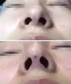 鼻综合整形前后判若两人,鼻尖很关键
