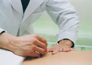毫针刺法
