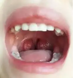 儿童扁桃体腺样体肥大需要手术吗
