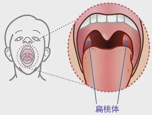 孩子扁桃体反复发炎,到底如何处理
