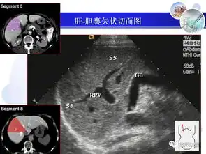肝脏的超声分叶分段超声解剖
