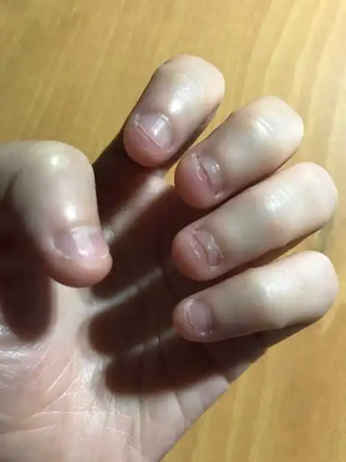 你的孩子还在咬指甲吗
