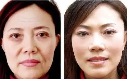 台湾第一名媛也靠整玻尿酸瘦脸针一个都不能少

