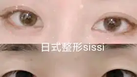 你适合做埋线双眼皮手术吗看看有什么优缺点西安
