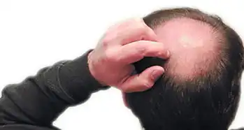 在相学中,聪明绝顶秃顶的男人有什么样的性格运势呢
