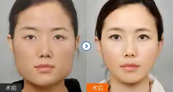 改脸型案例

