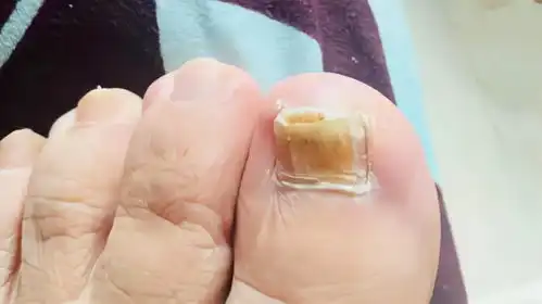灰指甲反反复复难断根那是你关键步骤没搞清
