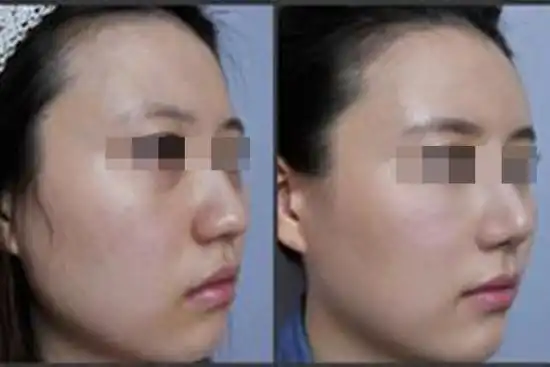眉弓填充前后对比照片
