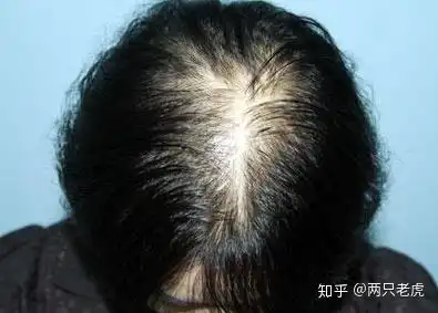 一个女孩子真的会秃吗
