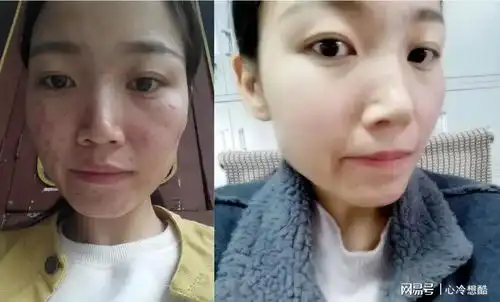 闭口粉刺最有用的药膏有哪些解析高效祛痘产品来啦
