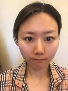 这两天黑眼圈有点重,当时做完还答应医生不要经常熬夜...去眼袋悦美整形
