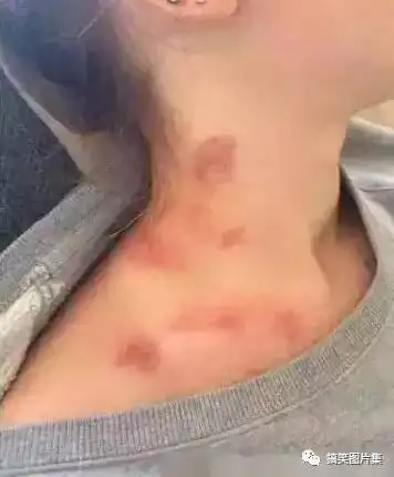 搞笑图片女友好可怜,脖子上满是过敏的痕迹
