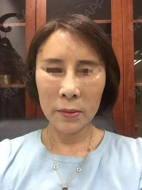 今天拍了一组照片做下反馈,做完小切口提升20天了,效...紧致提升悦美整形
