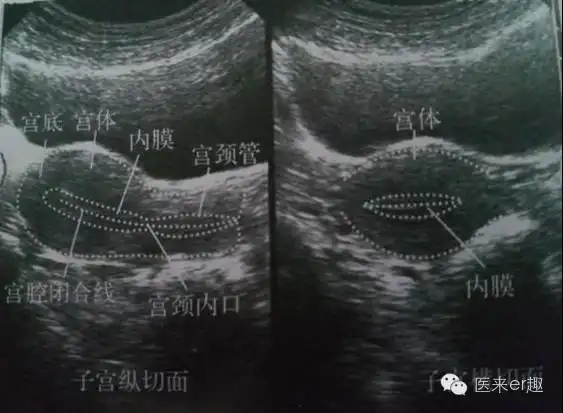 b超图解常见妇科疾病典型超声表现
