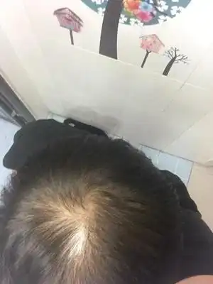夏天到了,这假发带的太热了,我还是真发织的假发套,不是哪种一次性假发生发纤维
