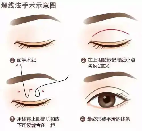 割双眼皮你不后悔吗后悔的是没有早点割
