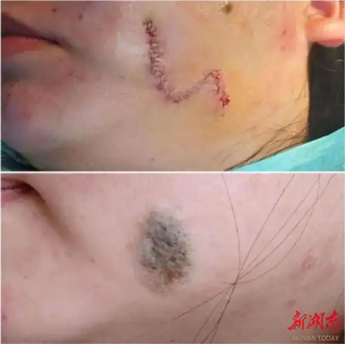 女孩脸上有大痣,医生说出现这种情况需当心癌变

