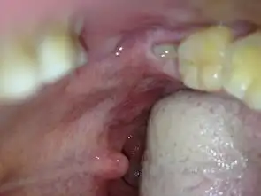 长了个智齿附有图片请问需要拔掉吗还有那个智齿旁边那个白色的是发炎了吗
