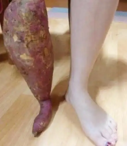 搞笑图片为了不去约会,她告诉男孩自己的腿被烧伤成山芋腿
