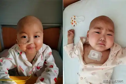 萌女娃突患罕见病,治疗前后模样大变,父亲车祸后又查出肿瘤
