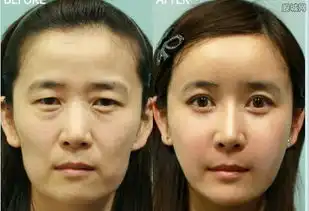 韩国明星整容后遗症后遗症非常恐怖让大家惊叹
