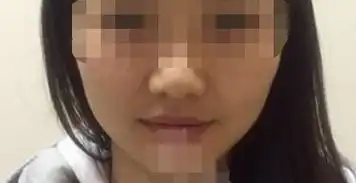 丑女线雕提升第一天图片美容蛋白线提拉后变美过程
