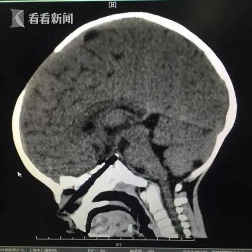 幼童玩耍跌倒20cm筷子直插大脑上海医生连夜抢救
