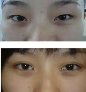 眼角开大
