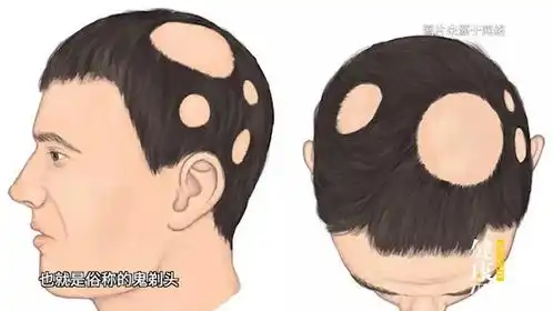 秃顶自救指南生姜擦头皮吃黑芝麻,拯救发量的这些方法靠谱吗
