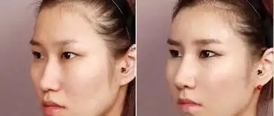 4个做隆鼻的女孩成为整容模板,她们用照片给出了答案
