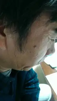 我爸爸脸上有个肉痣,他这个前一段总说痒给扣掉了,后来又长出来了,我不知道他这个算不算痣,是一个凸出
