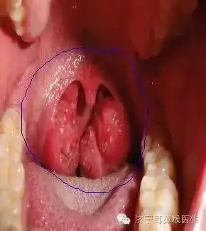 扁桃体该不该切除
