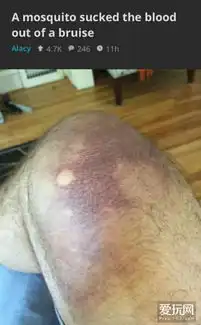 爱玩小编们的养伤记大爷级的宅男生活方式
