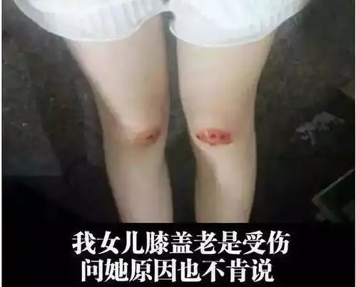 女儿膝盖老是受伤,问她原因也不肯说
