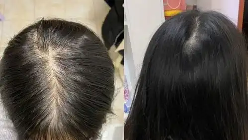 假发片拯救了脱发大军解决根源还得靠它,四个妙招赶紧学起来
