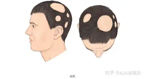 如何确定自己的脱发类型

