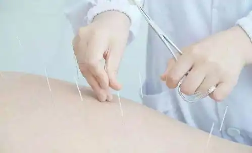 百黎堂中医馆针灸减肥的好处
