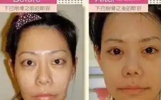 39岁女子整容21年,花37万元整容60次,从丑女瞬间变美女
