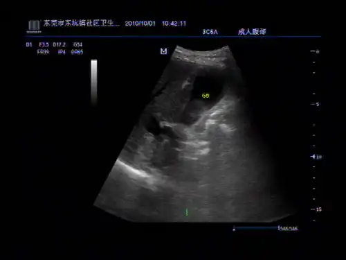 超声图片分析
