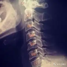 为什么颈椎病会导致头疼
