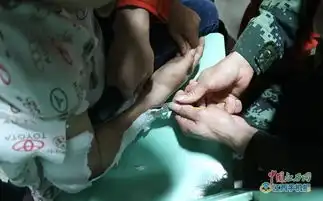 小男孩手臂被石膏紧咬难倒医生只得求助消防组图
