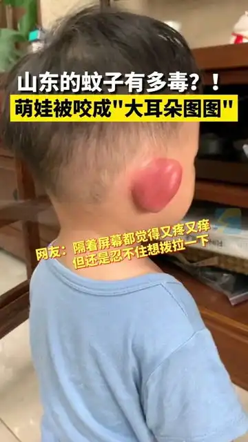 山东的蚊子有多毒青岛萌娃被咬成大耳朵图图,网友隔着屏幕都觉得又疼又痒
