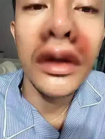 隆鼻8次,从屌丝逆袭文青男,此人真敢整
