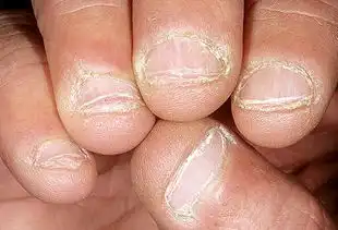 史上最全指甲断病
