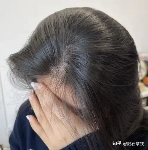一直掉头发怎么办有什么不费钱,让头发变浓密的办法
