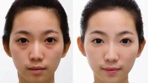 熬夜熬出黑眼圈不怕,这4种食物可以吃掉黑眼圈,试试
