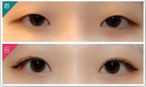 双眼皮眼部埋线多少钱
