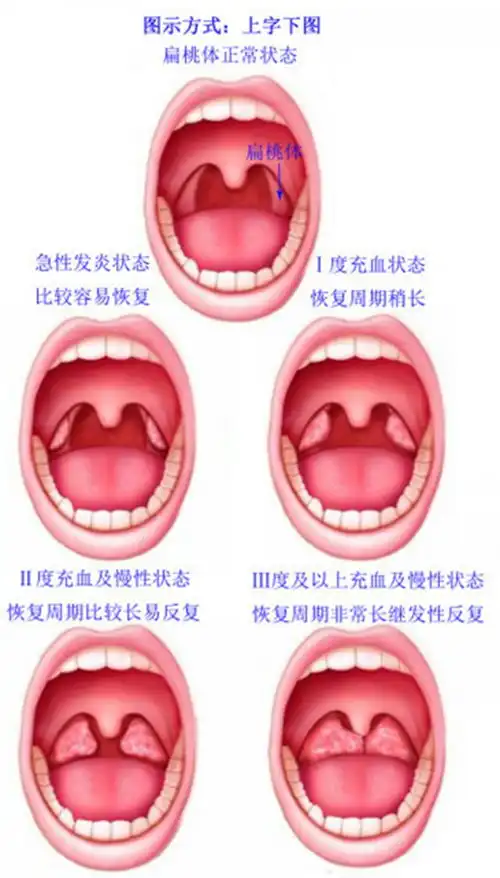 扁桃体炎图片扁桃体炎症状表现图片大全有来医生
