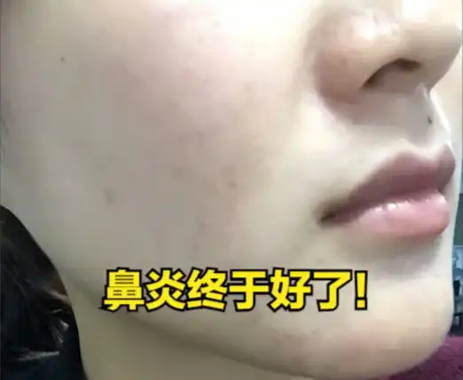 震惊7年鼻炎经验曝光,喷嚏眼泪直流3分钟搞定
